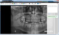 Medición sobre Ortopantomografías